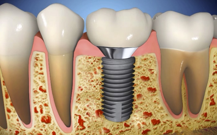 cosas importantes para conocer sobre implantes dentales